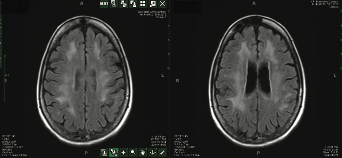 GanciclovirResistant Cytomegalovirus Encephalitis in a Patient With